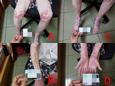 Case Report: Successful treatment with methotrexate in a 10-year-old boy with co-occurrence of generalized psoriasis and vitiligo